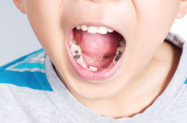 Cách chống sâu răng cho bé theo độ tuổi hiệu quả hơn cả đánh răng (1)